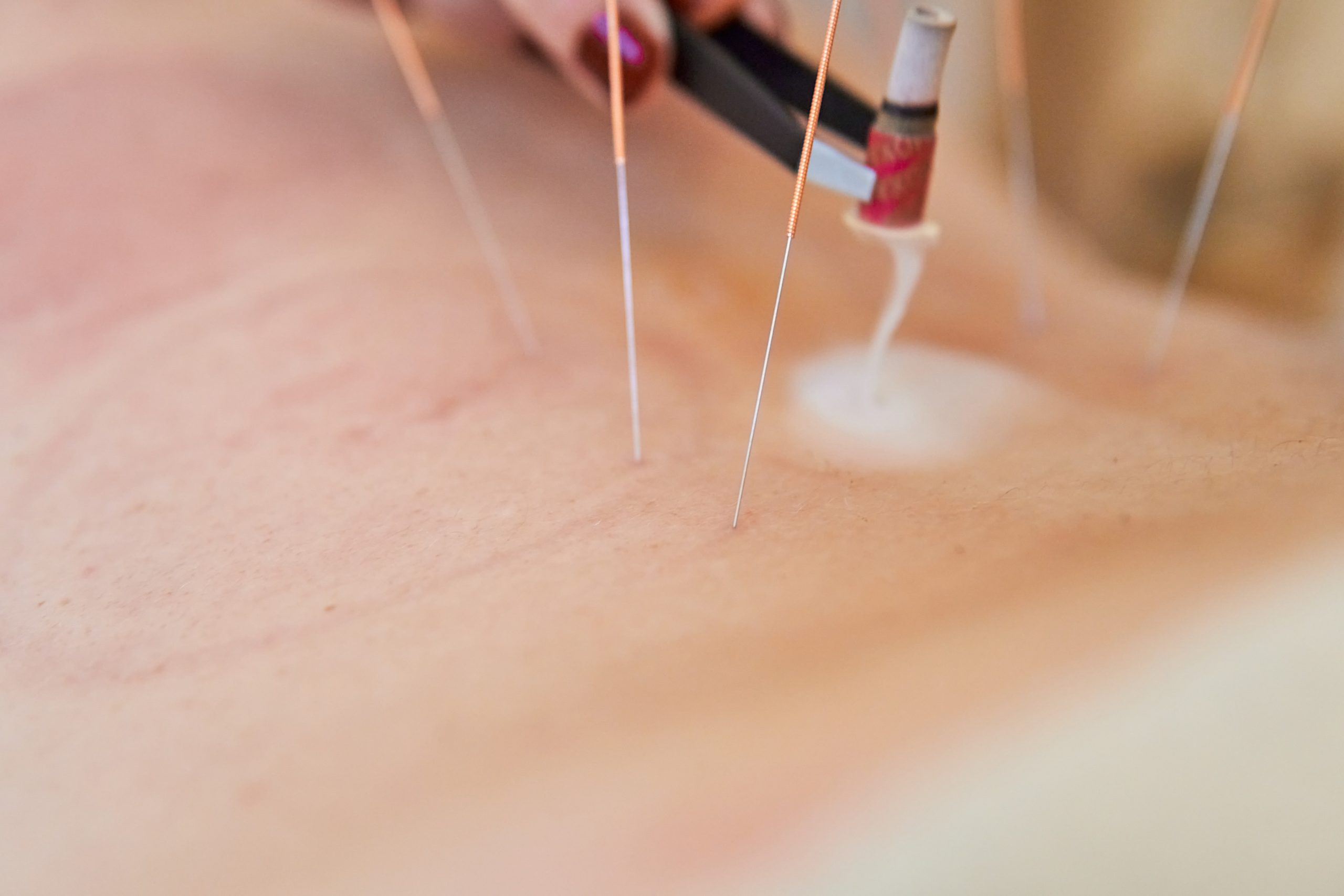 Dry Needling