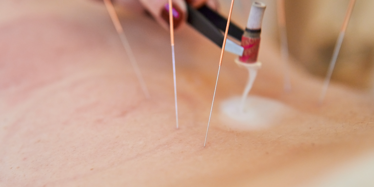 Dry Needling Dry Needling